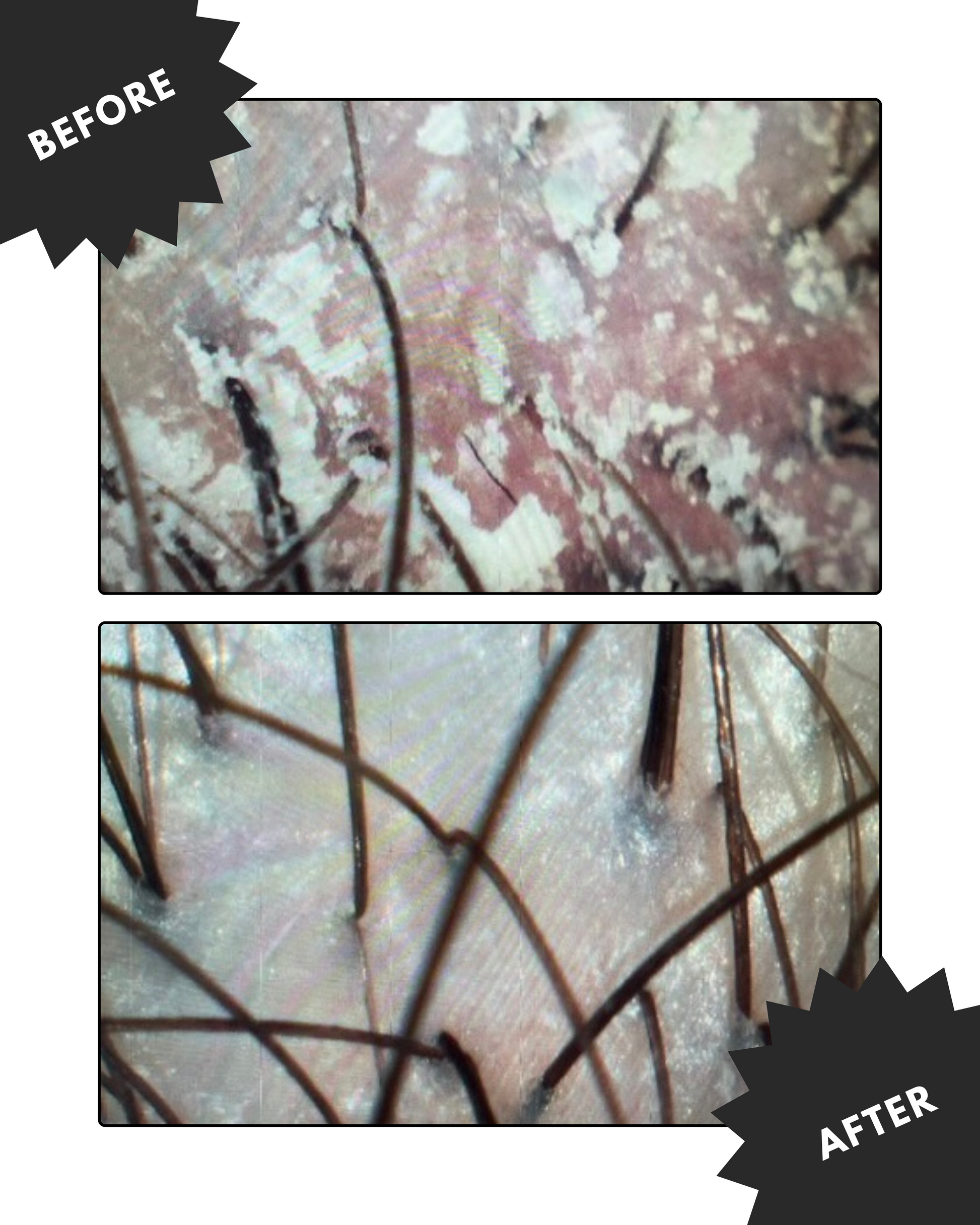 Silicone Scalp Scrubber | Scalp Buildup Remover | Hair Scalp Massager